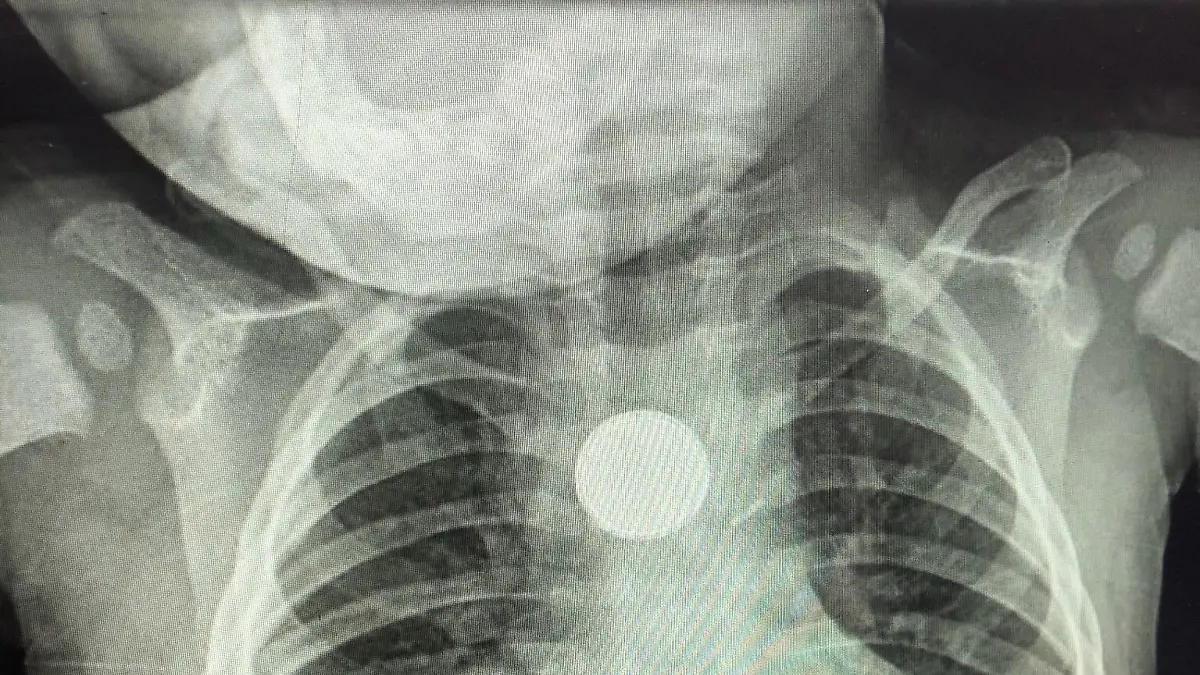 CATERS NEWS (PICTURED X-Ray of Ralphie's chest with the battery sitting in his chest) A baby was just 'minutes from death' after swallowing a button battery. One-year-old Ralphie, from Watford, Herts, is lucky to be alive after a small round battery began burning his insides. Initially, Hollie Phillips, 27, assumed Ralphie had eaten cereal off the floor but within a matter of minutes - he was crying and projectile vomiting. A metal detector at the hospital came back clear but Hollie, the charity event organiser, knew something was wrong with her boy. SEE CATERS COPY