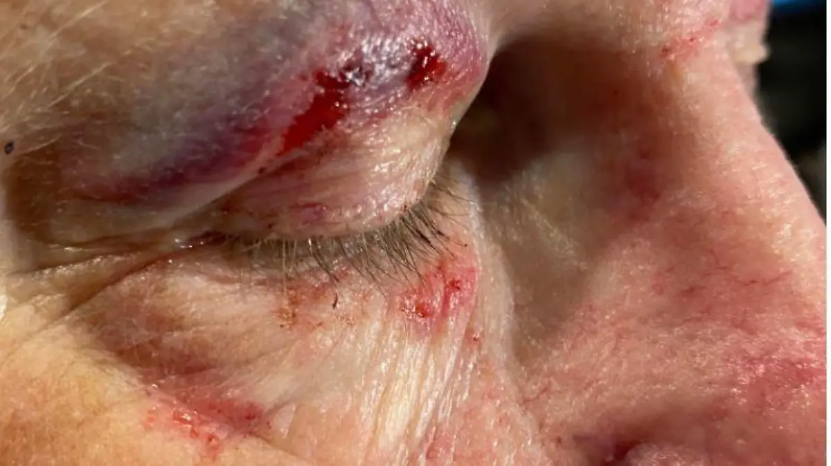 Bei dem Angriff von drei Jugendlichen hat der Busfahrer erhebliche Verletzungen erlitten.