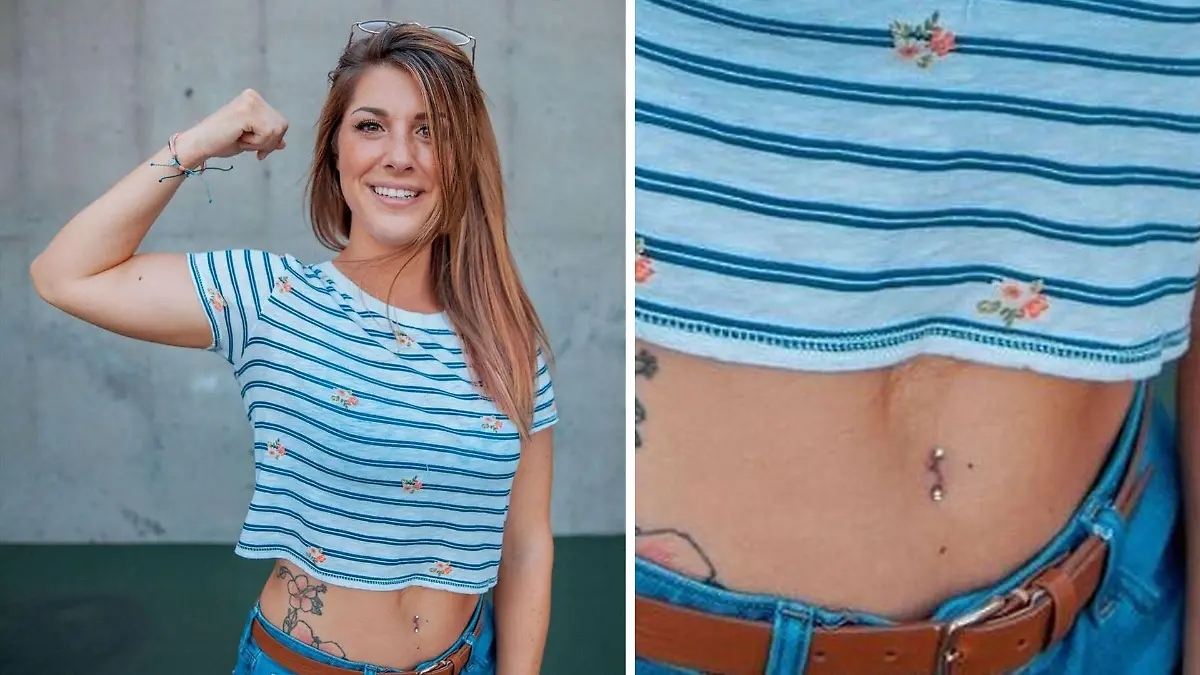 Jess Kaufman aus Kansas (USA) hat keinen Bauchnabel. Der Grund: Sie kam mit einem seltenen Geburtsfehler zur Welt.