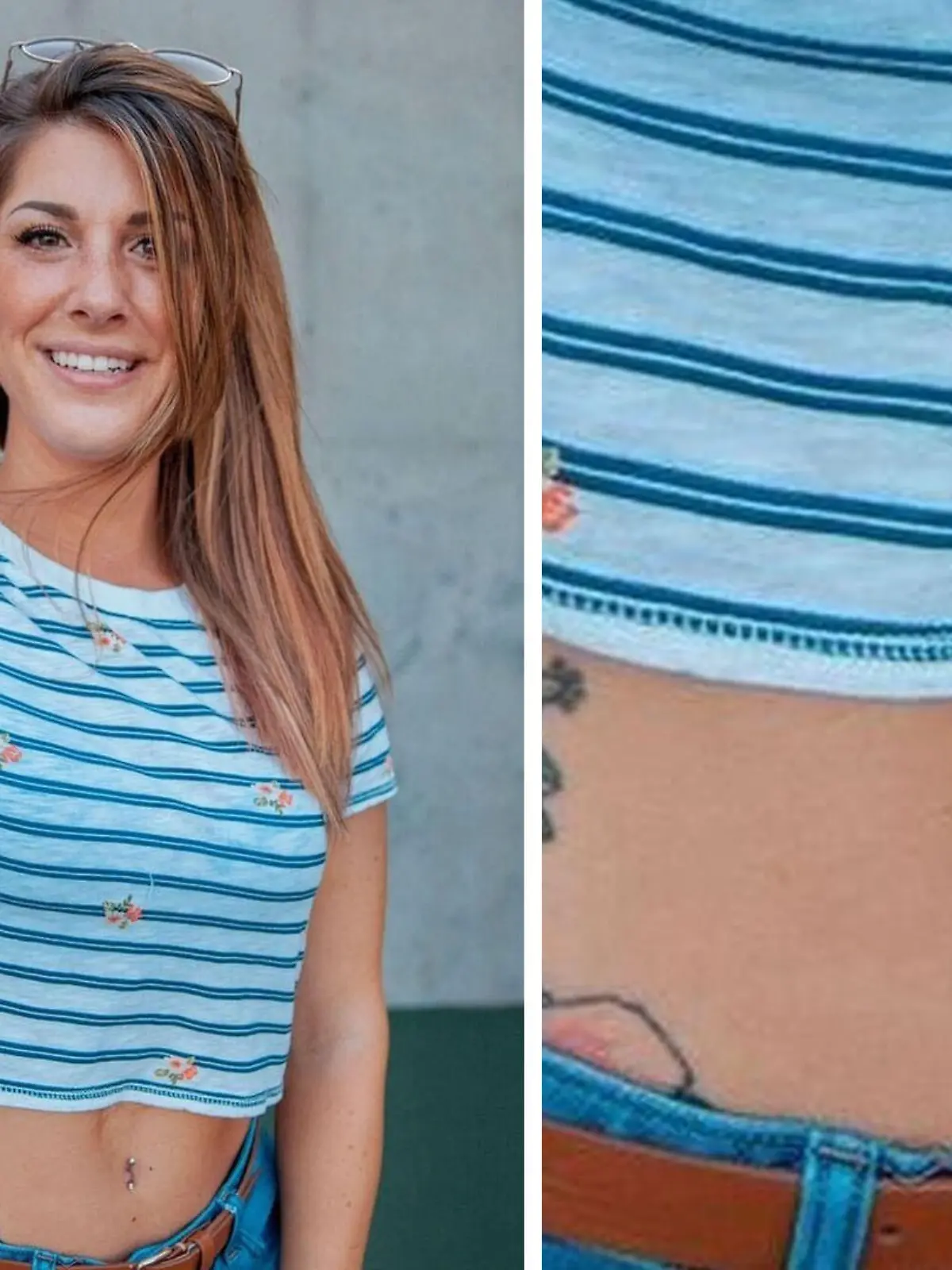 Jess Kaufman aus Kansas (USA) hat keinen Bauchnabel. Der Grund: Sie kam mit einem seltenen Geburtsfehler zur Welt.
