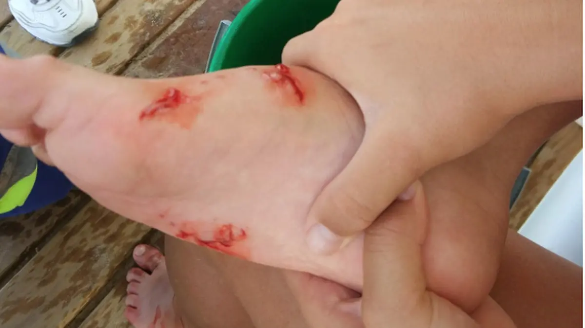 SONDERKONDITIONEN: Satzpreis! Ab ins Krankenhaus: Frau wird von einem aggressiven 1,2 Meter langen Fisch an der Costa Blanca gebissen 

A WOMAN has been taken to hospital after being bitten by a fish on a Costa Blanca beach blamed for a number of previous attacks on tourists.
This pic:Woman being attended by Lifeguards after the fish bite
