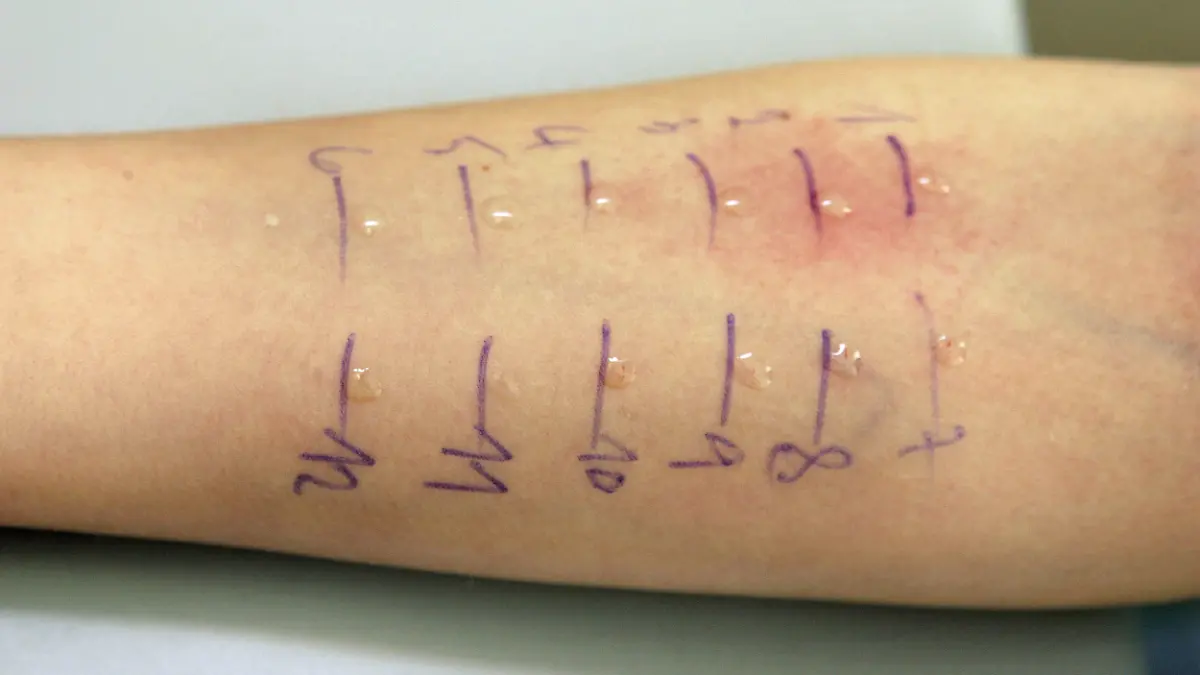 Ein Allergietest (Prick-Test) auf dem Unterarm eines zehnjährigen Mädchens am Mittwoch (22.03.2006) in einer Arztpraxis in Mainz. Bei einem Allergietest werden verschiedene Allergene in Tropfenform auf die Innenseite des Unterarms aufgetragen. Hier wird die Haut dann mit Hilfe einer feinen Lanzette oder Nadel oberflächlich eingestochen, was dem Patienten in der Regel keine Schmerzen bereitet. Der Prick-Test ist eine Standard-Untersuchung, mit der vor allem Allergien vom Soforttyp (Typ I) nachweisbar sind. Solche Allergien sind Überempfindlichkeits-Reaktionen, die durch den Kontakt mit bestimmten Substanzen (Allergenen), wie z.B. Pollen ausgelöst werden. Innerhalb von Sekunden bis Minuten können beispielsweise Juckreiz, Niesattacken, Naselaufen, Augenjucken und Quaddeln (stecknadel- bis handtellergroße rundliche, weißliche bzw. rötliche Hauterhebungen) auftreten. Foto: Frank May dpa/lrs +++(c) dpa - Report+++