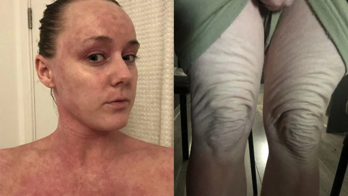 Beth sagt über die Effekte des Cortison-Absetzens: "Ich habe mich nur noch als Alien bezeichnet."