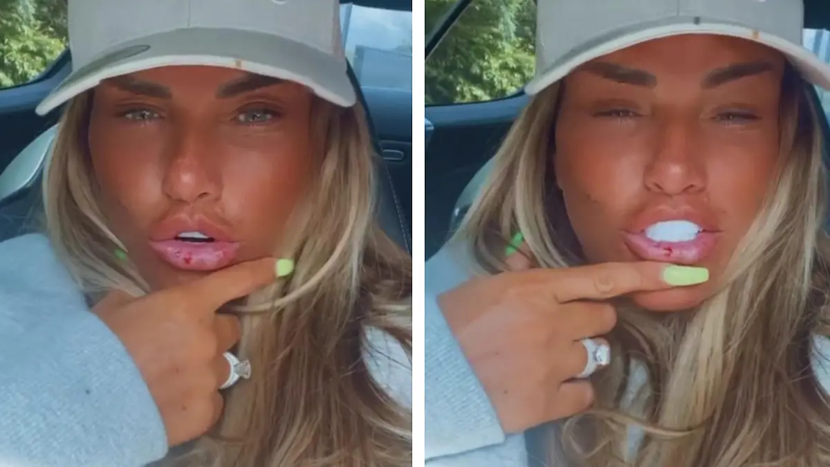 Katie Price zeigt ihre blutige Lippe.