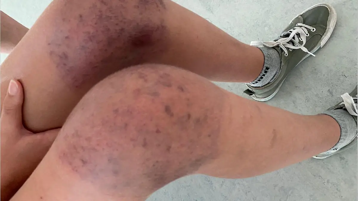 Die Knie der 13-jährigen Schülerin sind von blauen Flecken übersäht.