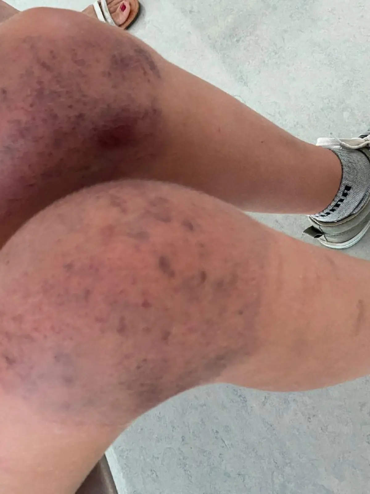 Die Knie der 13-jährigen Schülerin sind von blauen Flecken übersäht.