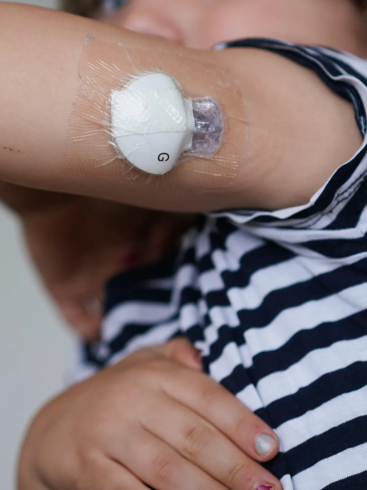 PRODUKTION - 03.08.2021, Berlin: Der vierjährige Oskar zeigt einen Sensor an seinem Arm, der seinen Blutzucker misst. In Deutschland erkranken immer mehr Kinder und Jugendliche an Diabetes mellitus Typ 1. Dass auch völlig gesunde, sportliche, aktive Kinder und Jugendliche Diabetes bekommen können, ist vielen Menschen nicht klar. (zu dpa «Plötzlich Diabetiker: Es kann schon die Jüngsten treffen») Foto: Jörg Carstensen/dpa +++ dpa-Bildfunk +++