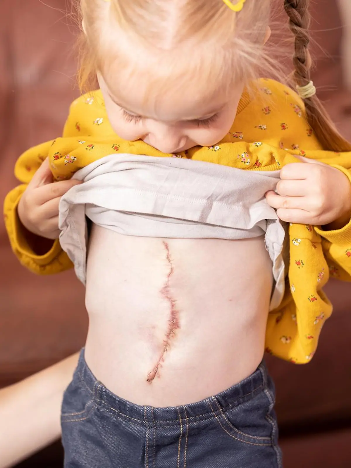 Laurel zeigt stolz ihre OP-Narbe: Jetzt beginnt für die 3-Jährige und ihre Eltern ein sorgenfreieres Leben.