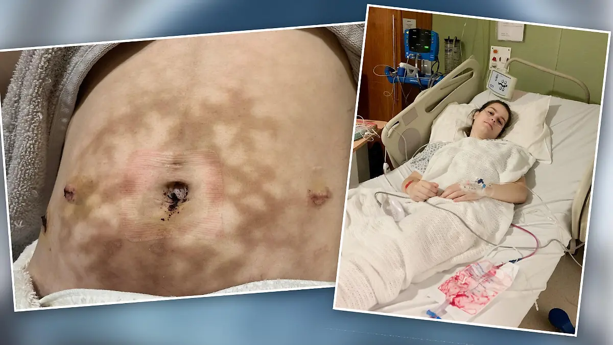 Die einzige Erleichterung für eine Mutter aus Manchester bei ihren Endometriose-Schmerzen: eine Wärmflasche. Von ihr bekam die junge Frau allerdings schlimme Verbrennungen.