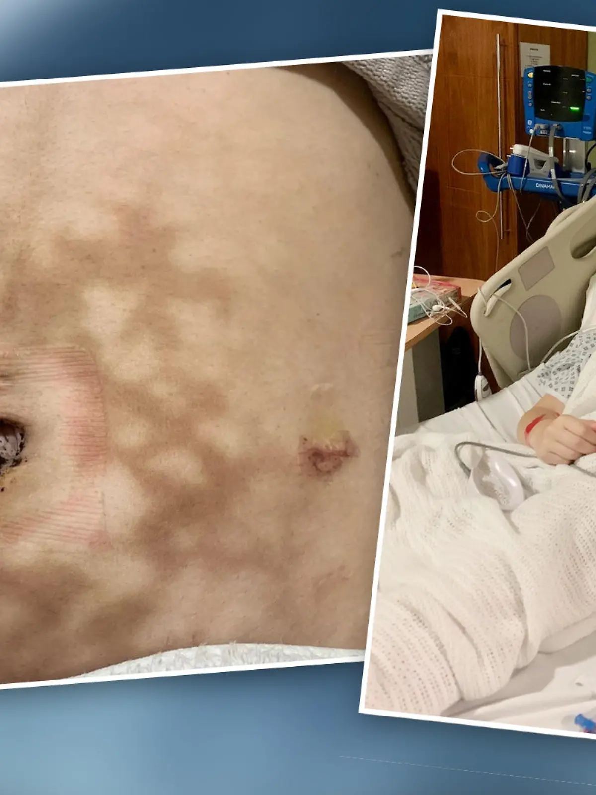 Die einzige Erleichterung für eine Mutter aus Manchester bei ihren Endometriose-Schmerzen: eine Wärmflasche. Von ihr bekam die junge Frau allerdings schlimme Verbrennungen.