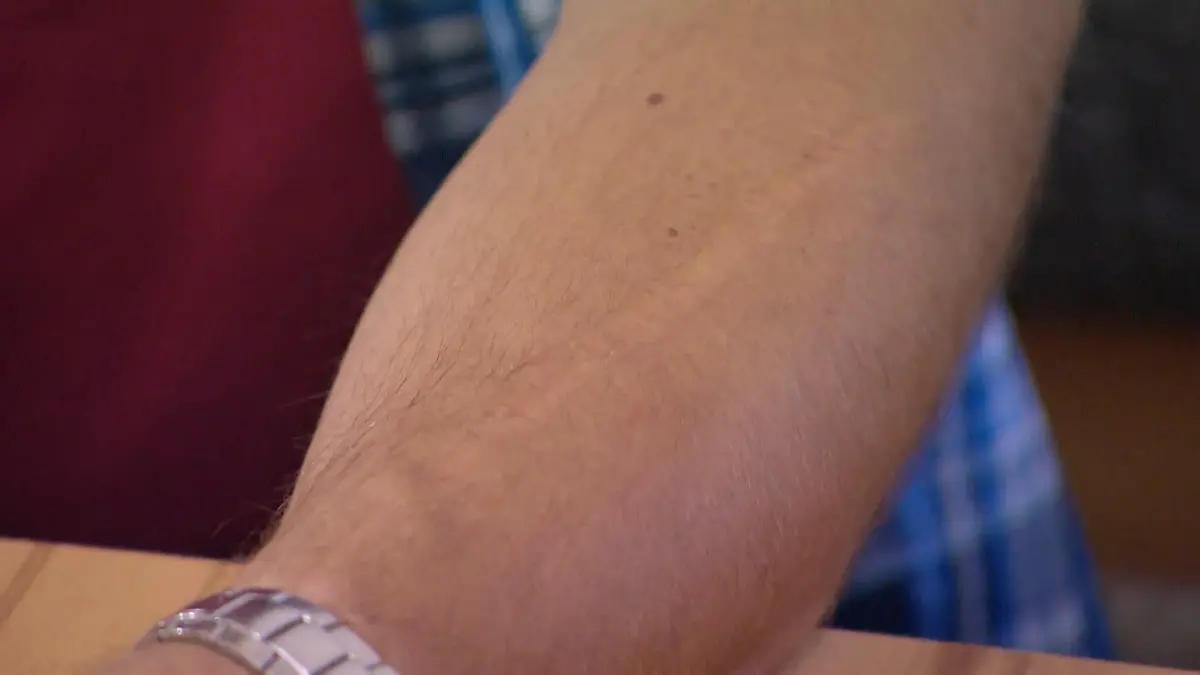 Narbe von Bauer Thomas 