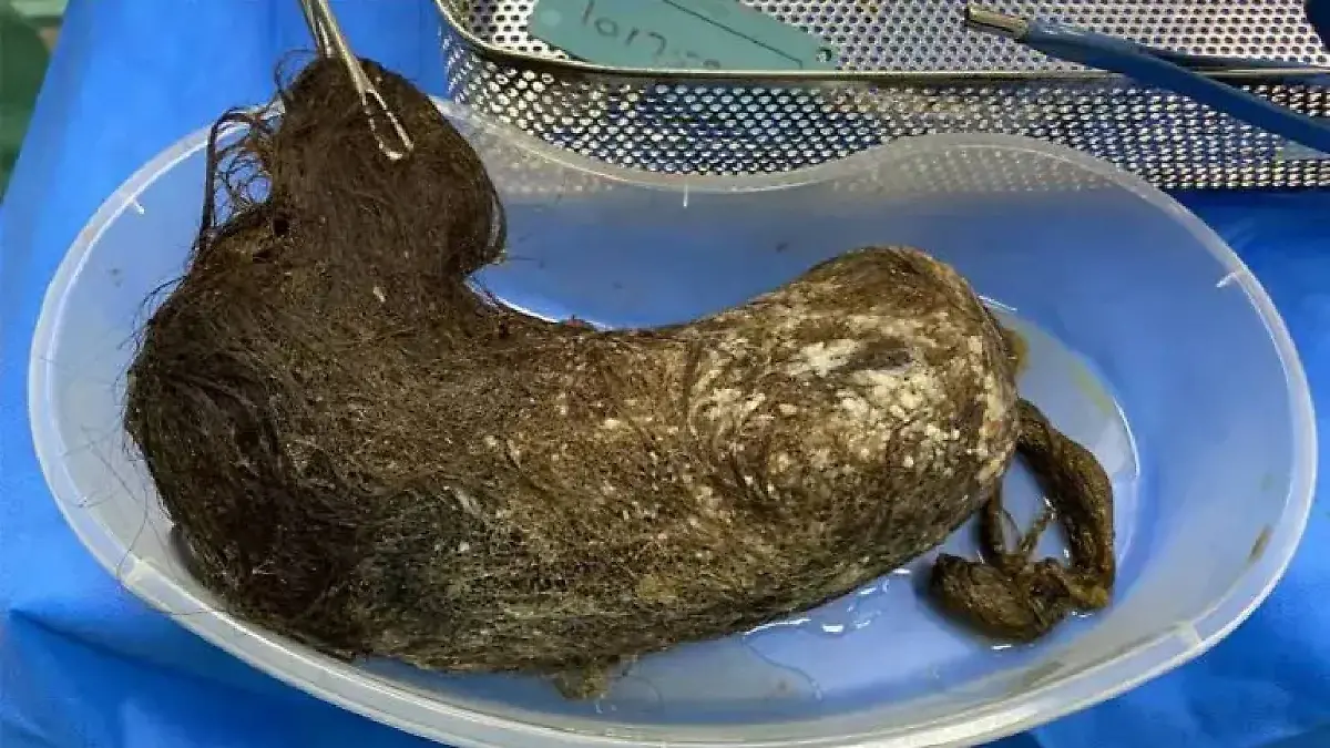 Im Magen des Mädchens befanden sich 283 Gramm Haare.