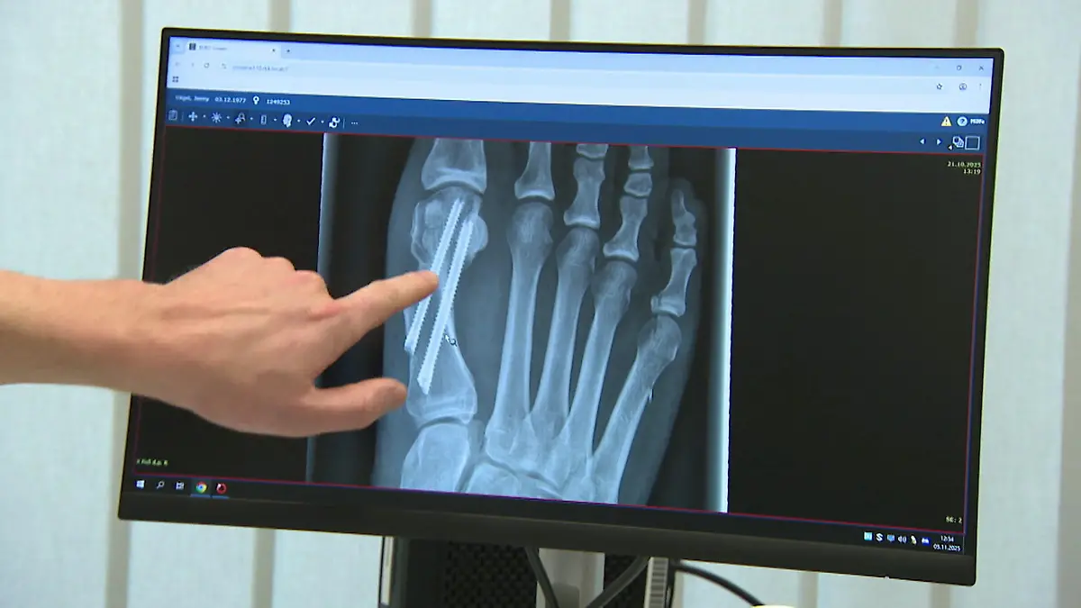Oh weh, der Zeh! Neue OP hilft bei Hallux Valgus Ohne sichtbare Narben