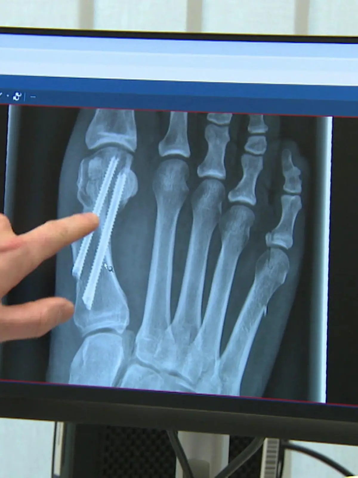 Bild zu: "Oh weh, der Zeh! Neue OP hilft bei Hallux Valgus"