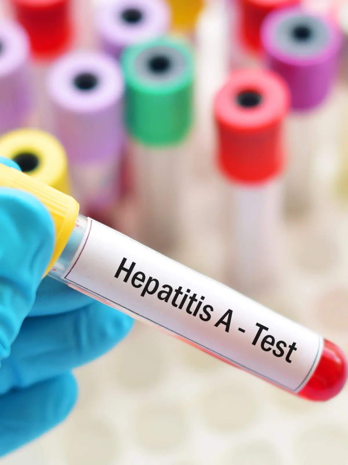 Hepatitis-A-Test (Symbolfoto) 