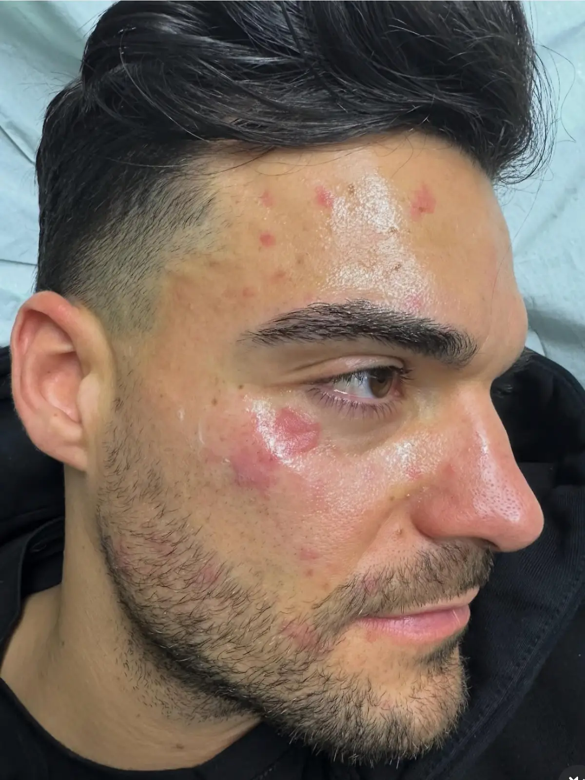 Bild zu: "Stefano Zarrella verbrennt sich beim Kochen das Gesicht – Bruder Giovanni reagiert sofort"