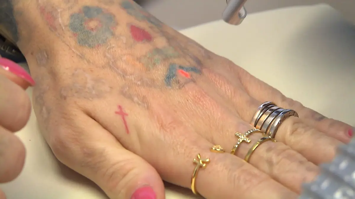 Tattooentfernung endet im Albtraum Narben statt makellose Haut