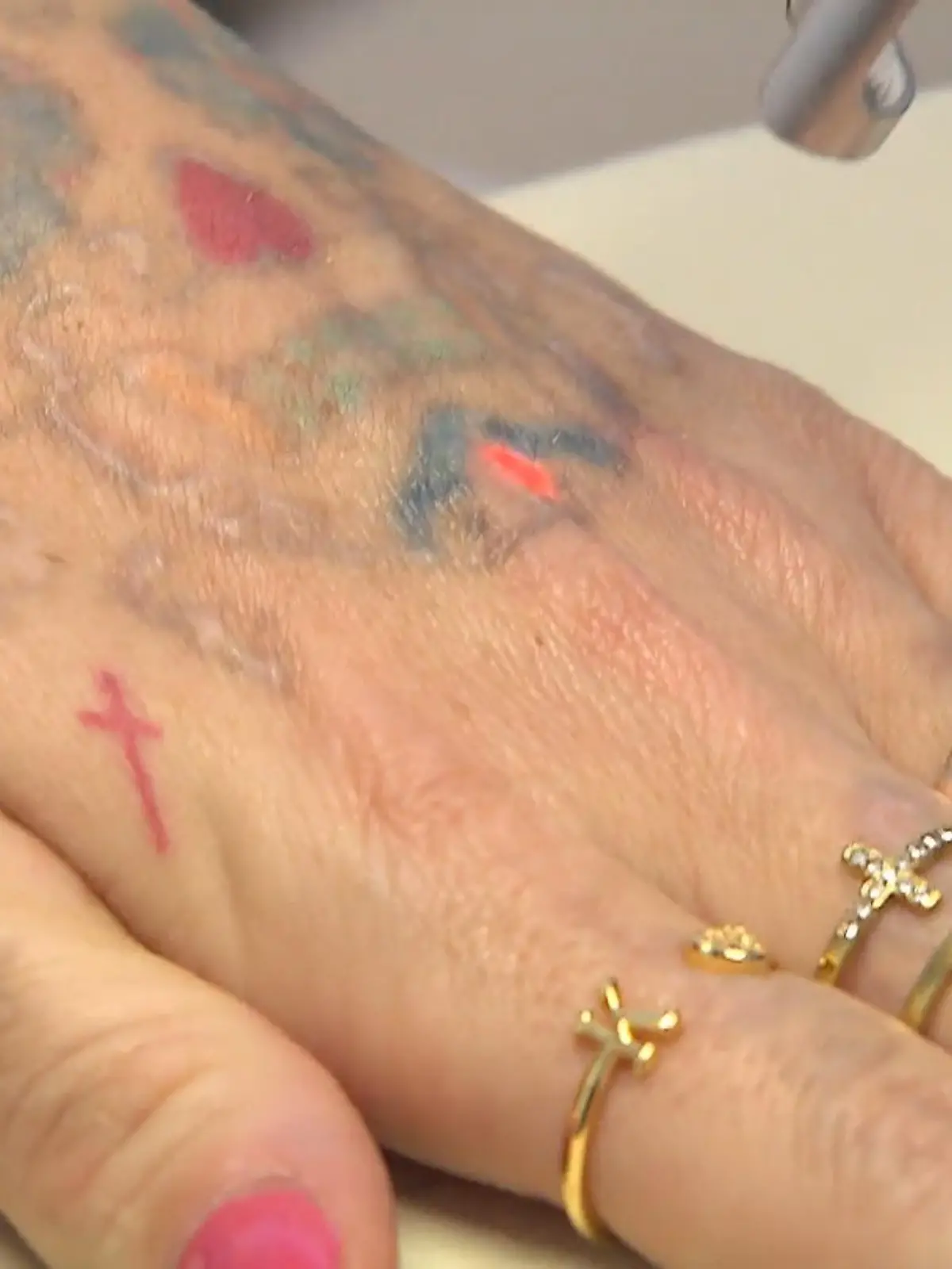 Bild zu: "Tattooentfernung endet im Albtraum"