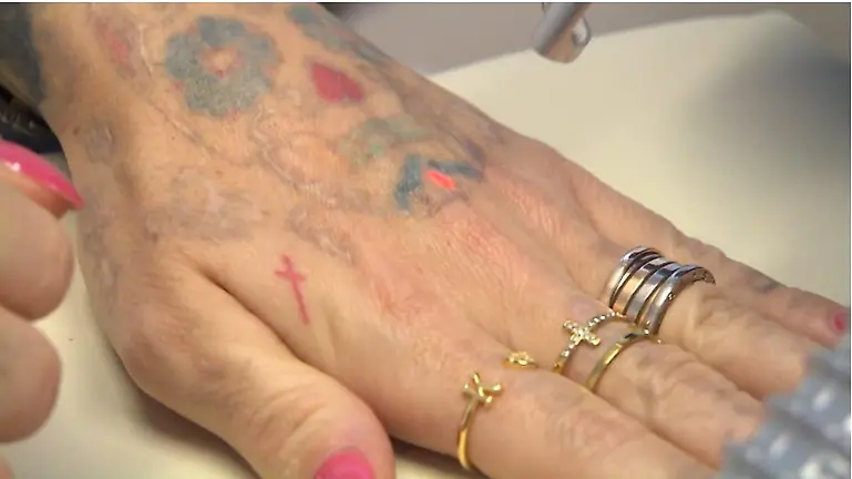 Pfusch-bei-Tattoo-Entfernung