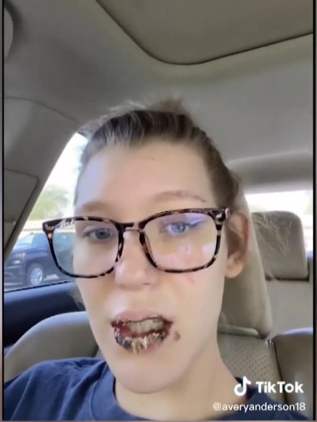 Die US-Amerikanerin Avery hat auf ihrem TikTok-Profil in ihren Videos über die krassen Nebenwirkungen berichtet, die sie einem verschreibungspflichtigen Akne-Medikament und einer Covid-19-Infektion zu verdanken hat. Ihre Lippen sind nach der Infektion nicht nur trocken, rissig und schuppig, sondern regelrecht mit Blasen und einer dicken Kruste übersät. Doch es sollte noch schlimmer kommen. Die Diagnose: "Schwarzer Pilz".
