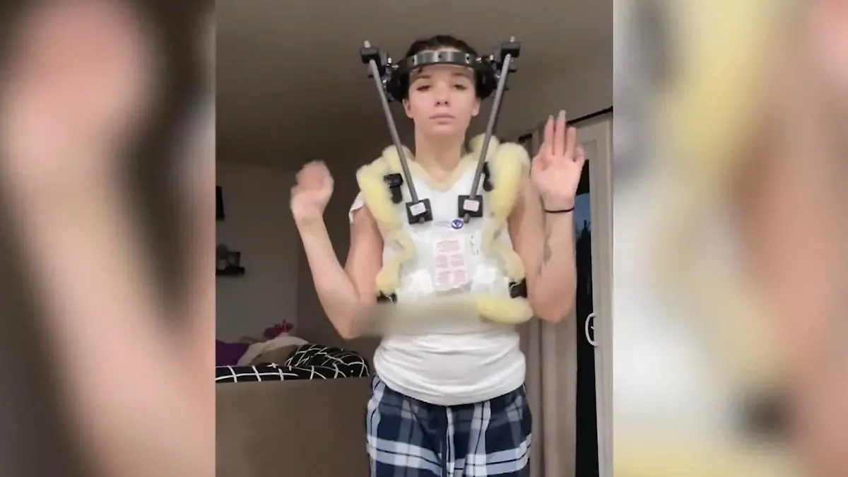 Halo-Fixateur-sch-tzt-sie-vor-L-hmung-Jordyn-25-lebt-monatelang-mit-Schrauben-im-Kopf