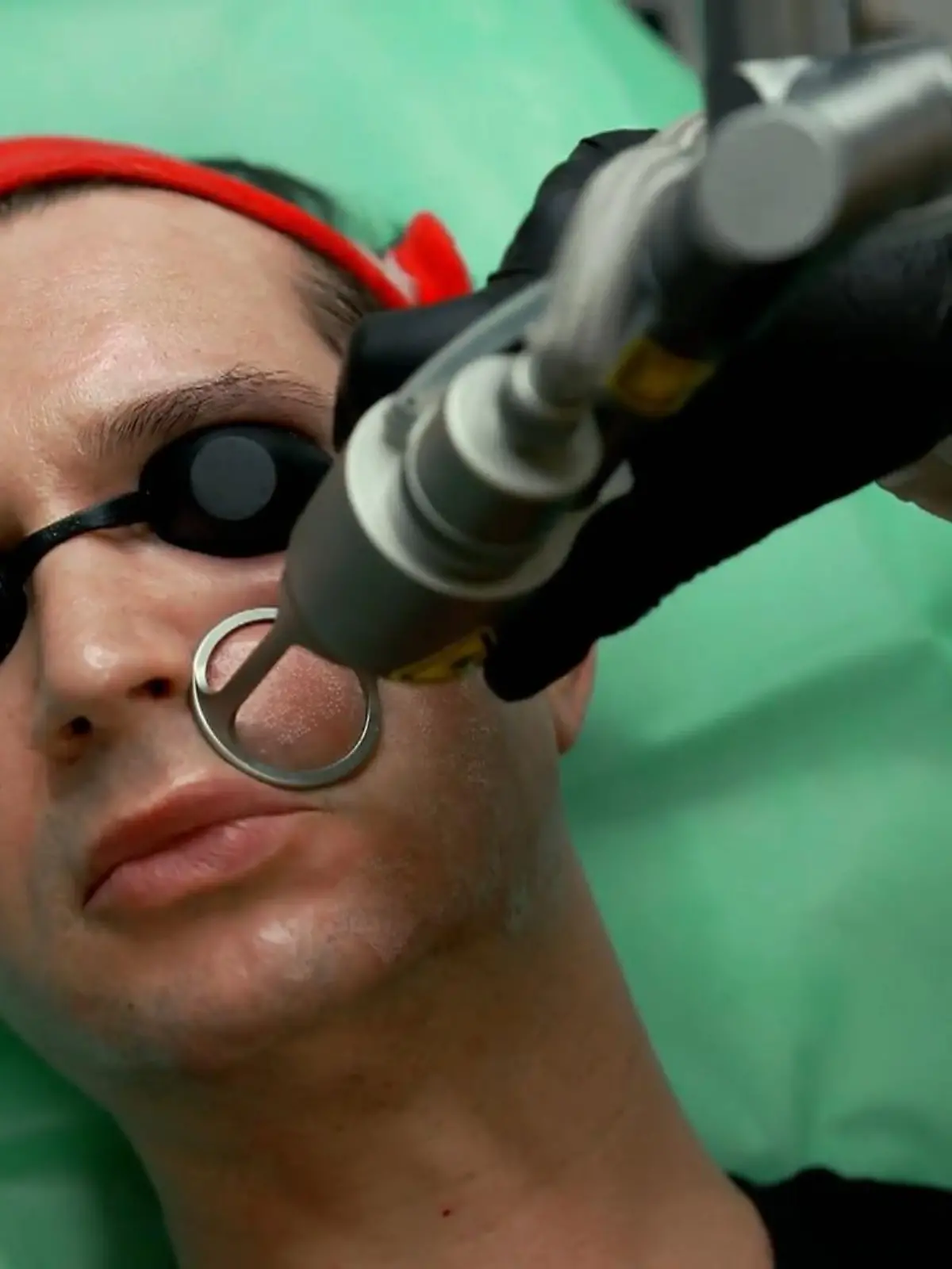 Bild zu: "Reporter testet umstrittene CO2-Laser – schenkt uns DAS die perfekte Haut?"