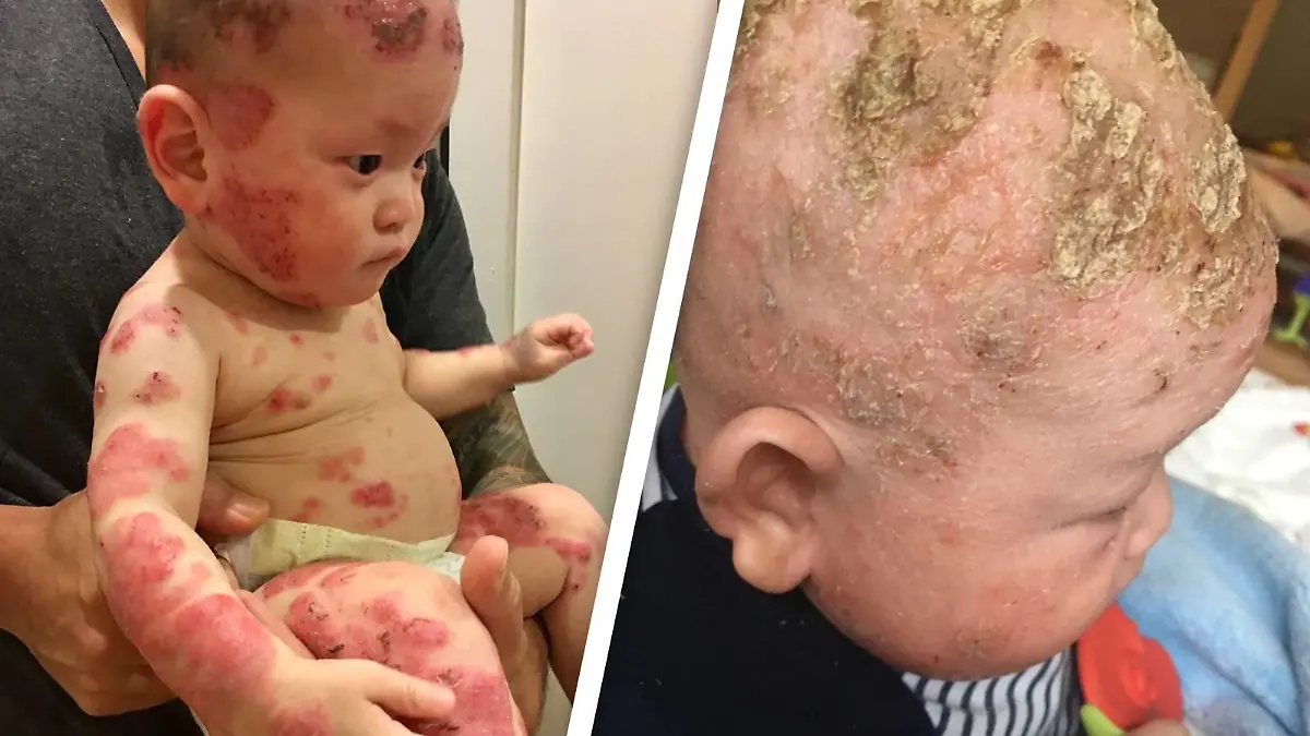 Der kleine Colby litt über Monate hinweg an schlimmen Ausschlägen.