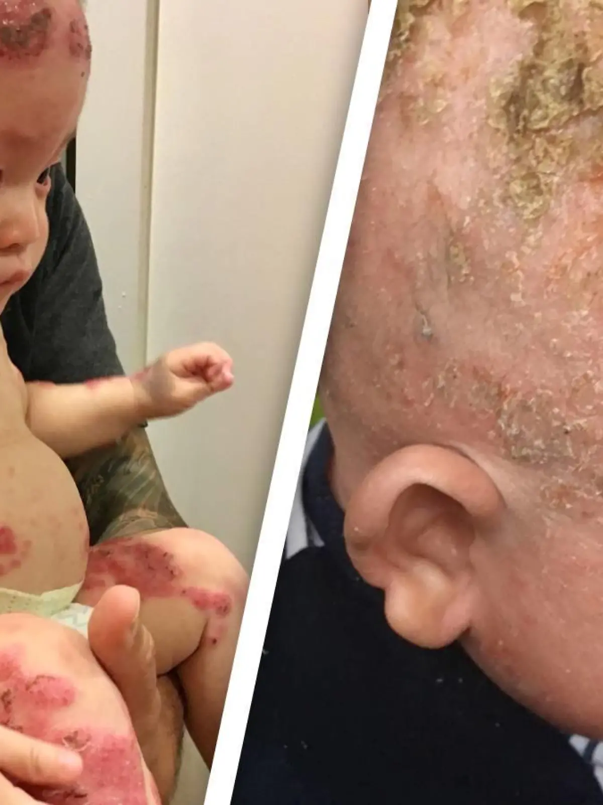 Der kleine Colby litt über Monate hinweg an schlimmen Ausschlägen.