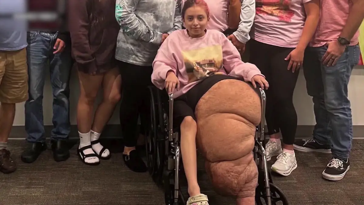 Tumor wuchert unkontrolliert! Teenagerin (14) bekommt 80-Kilo-Bein amputiert Für ihre Erkrankung gibt es keinen Namen