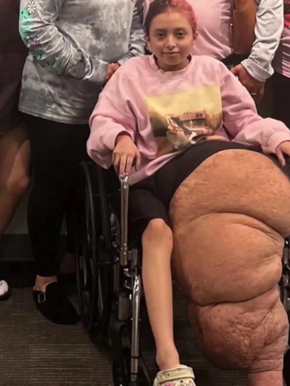 Bild zu: "Tumor wuchert unkontrolliert! Teenagerin (14) bekommt 80-Kilo-Bein amputiert"