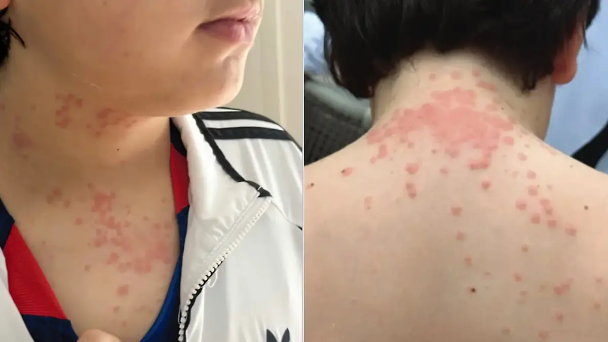 Virginia-USA-Bettwanzen-terrorisieren-Familie-Albuquerque-auf-Flug-von-KLM-Royal-Dutch-Airlines