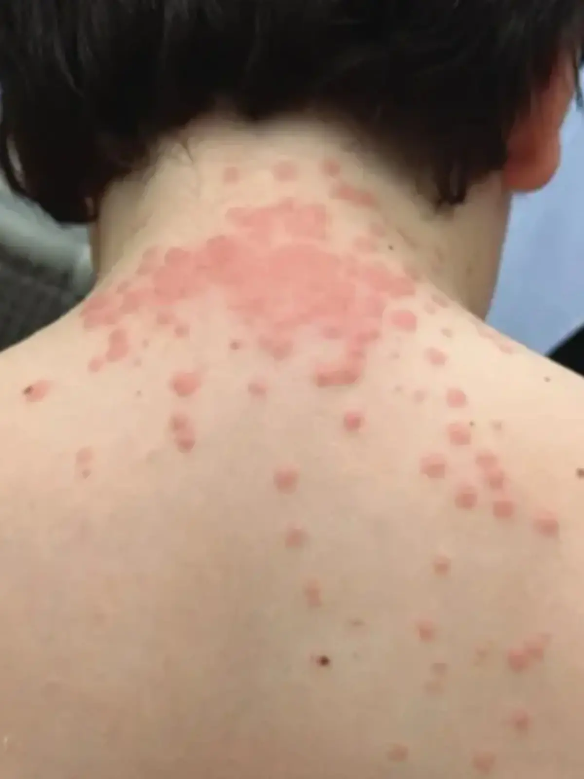 Bild zu: "Rote Flecken und juckender Ausschlag! Bettwanzen terrorisieren Familie auf KLM-Flug"