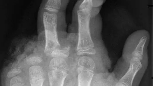 Silvester-diese-Folgen-durch-B-ller-Verletzungen-bleiben-ewig-