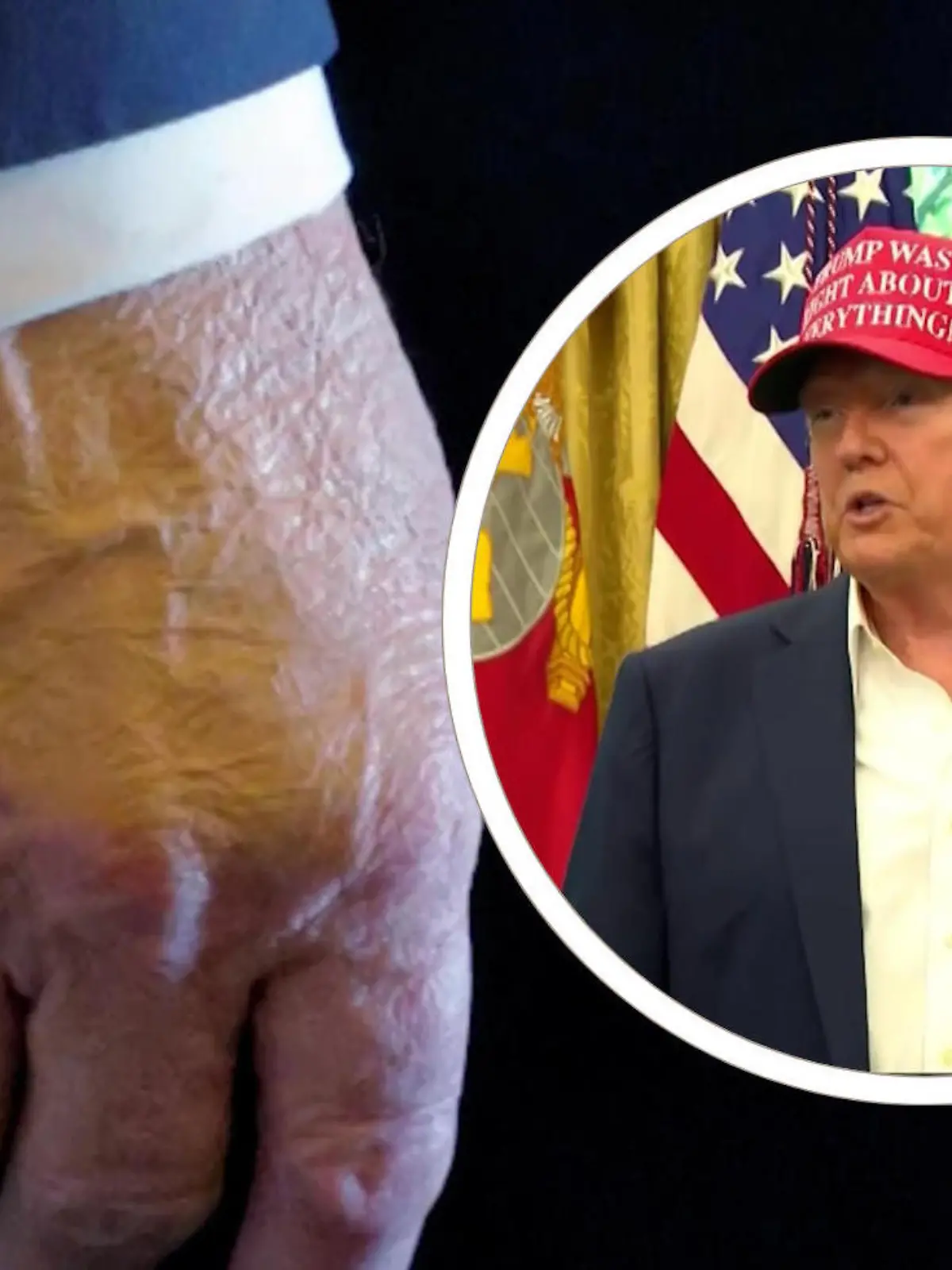 Bild zu: "Mysteriöse Flecken an der Hand! Donald Trump gesteht hohen Medikamentenkonsum"