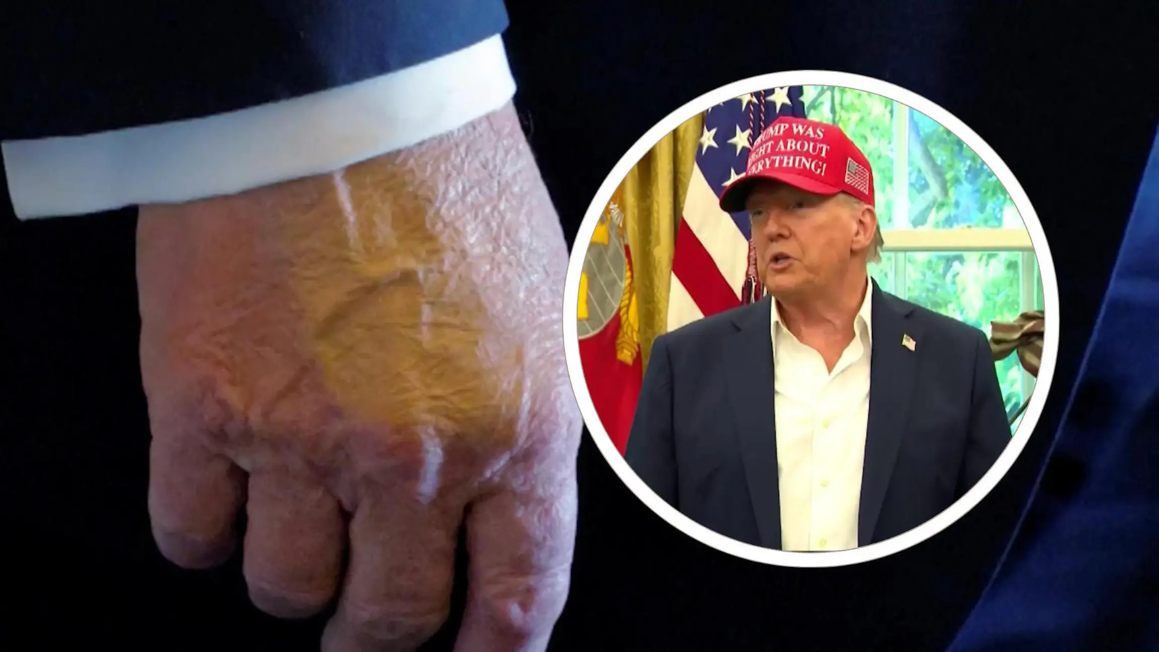 Mysteriöse Flecken an der Hand! Donald Trump gesteht hohen Medikamentenkonsum Obwohl Ärzte ihn warnen