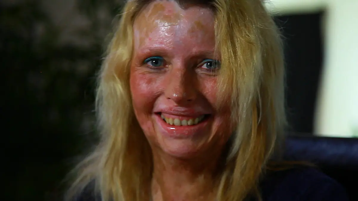 Dana Rudersdorf kann wieder lachen Ehemann zündet sie an