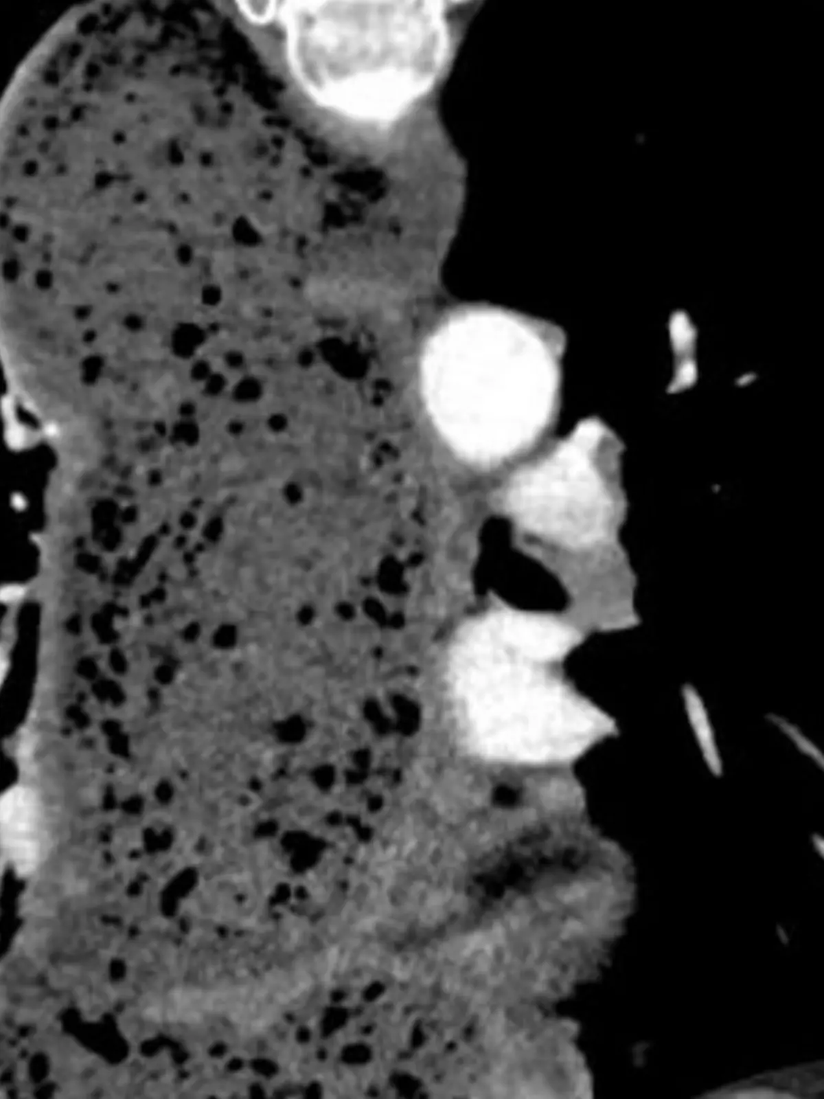 Bild zu: "Frau hat drei Liter Essen in der Speiseröhre"