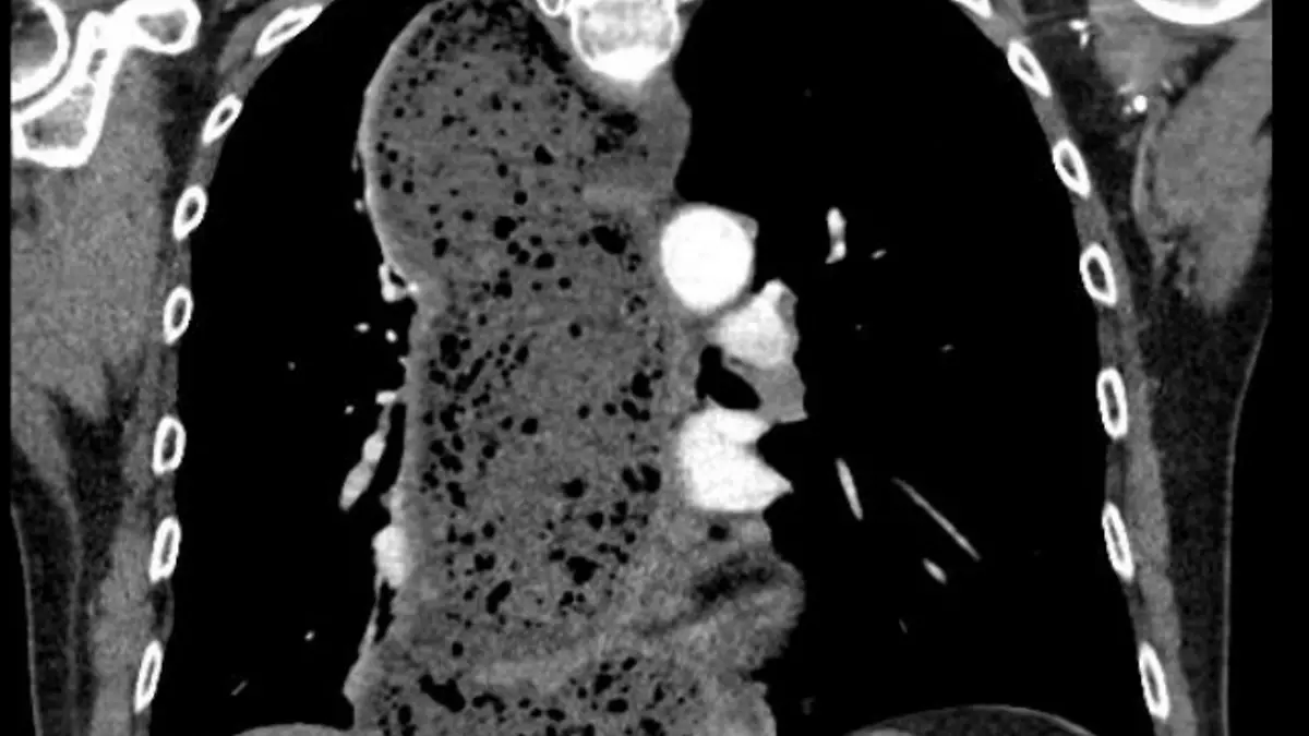 Speiseröhre_Helios Kliniken Mittelweser.jpg