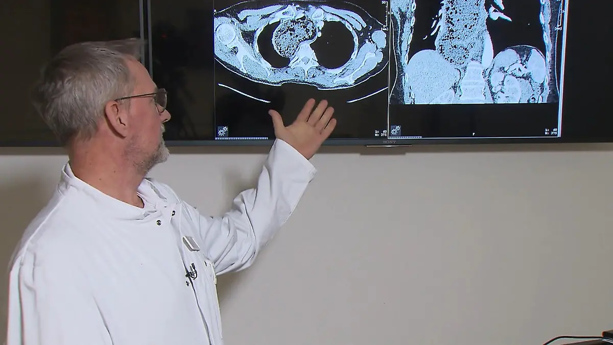 Frau hat literweise Essen in der Speiseröhre Erst Operation schafft Abhilfe