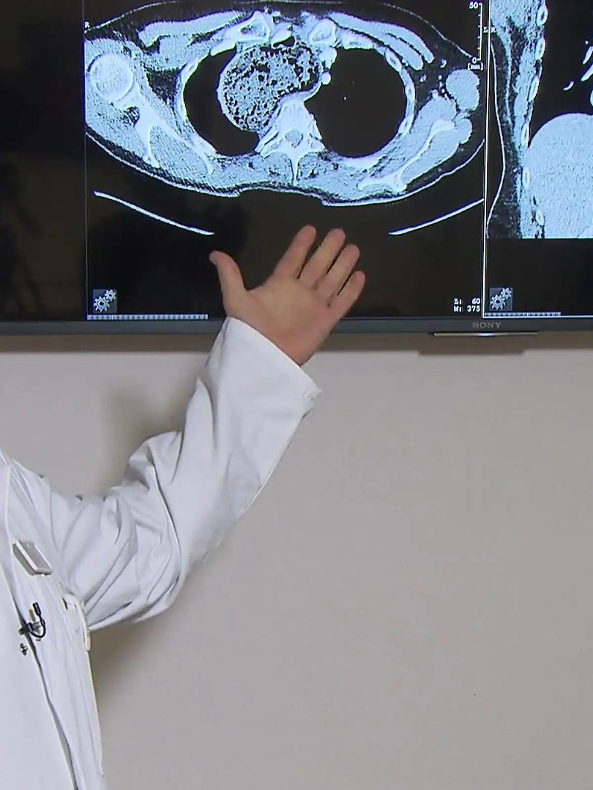 Bild zu: "Frau hat literweise Essen in der Speiseröhre"