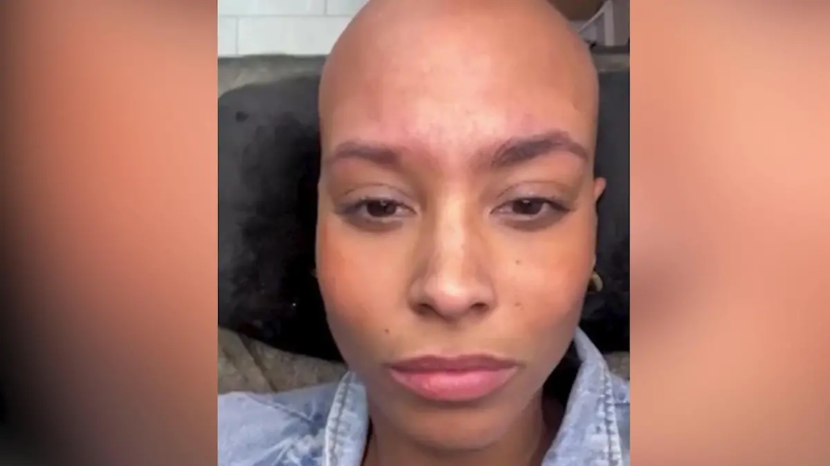 Erst Haarausfall, jetzt DAS! Ex-„Let's Dance"-Star klagt über akuten Schub Sharon Battiste hat Alocepia areata