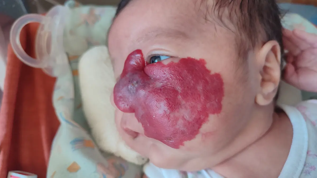 Argentinien-Baby-w-chst-riesiger-Tumor-im-Gesicht