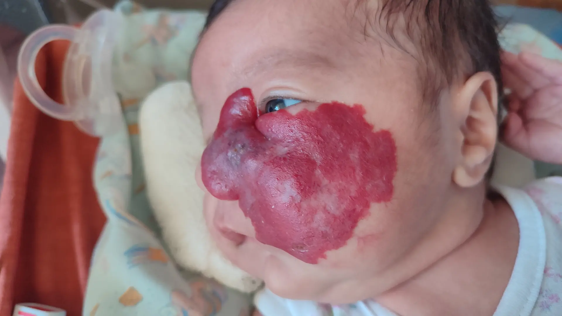 Ein übergrosses Hämangiom: Der Tumor von Baby Roma Emilia Bertoli aus Argentinien hat die Nase zur Seite ihres Gesichts verschoben