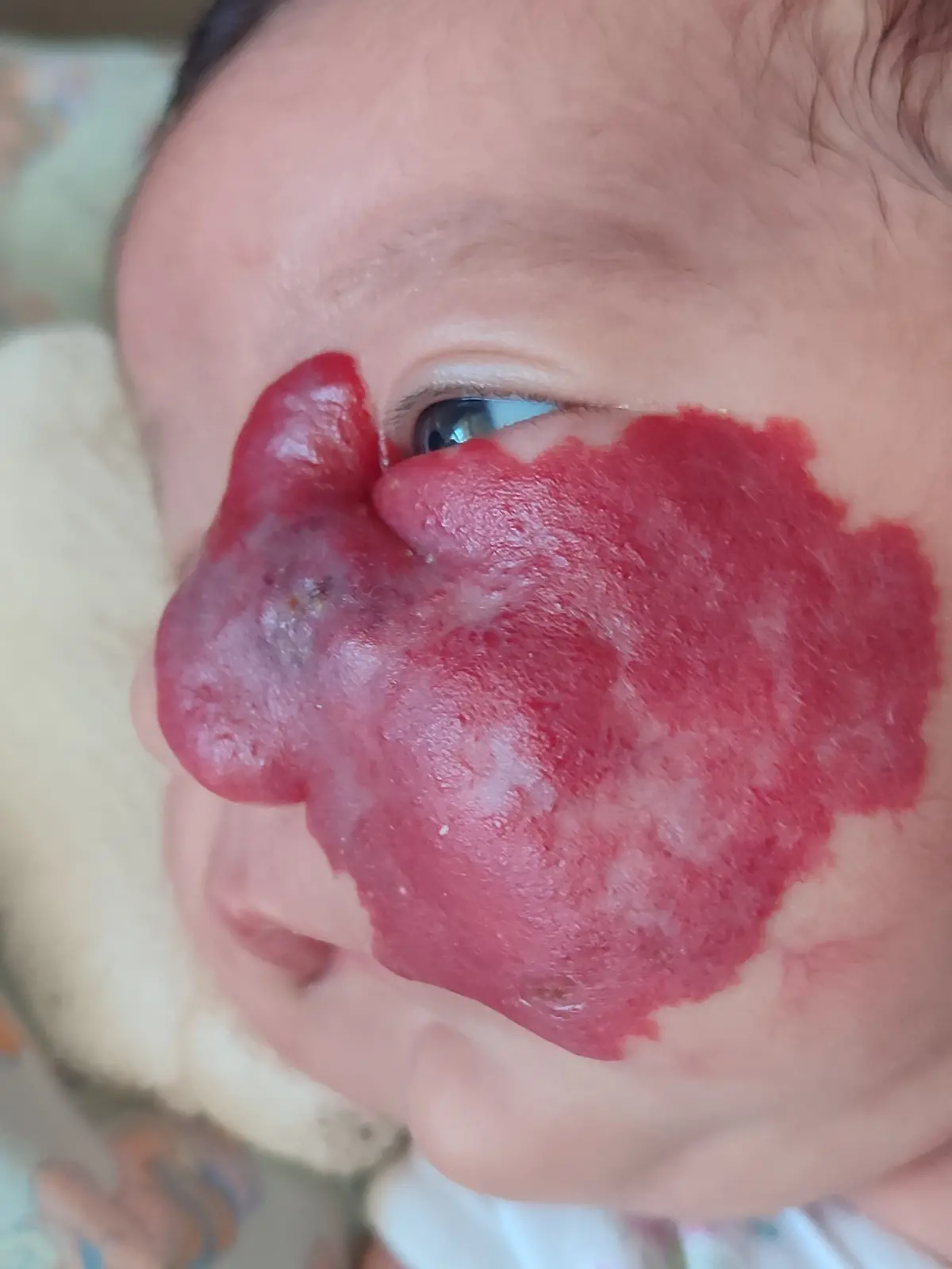 Ein übergrosses Hämangiom: Der Tumor von Baby Roma Emilia Bertoli aus Argentinien hat die Nase zur Seite ihres Gesichts verschoben