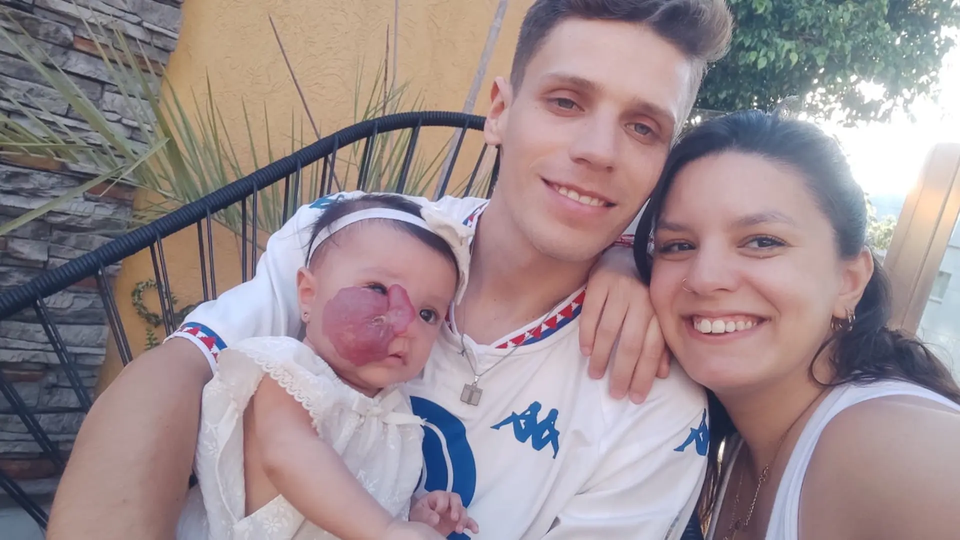 Ein übergrosses Hämangiom: Der Tumor von Baby Roma Emilia Bertoli aus Argentinien hat die Nase zur Seite ihres Gesichts verschoben