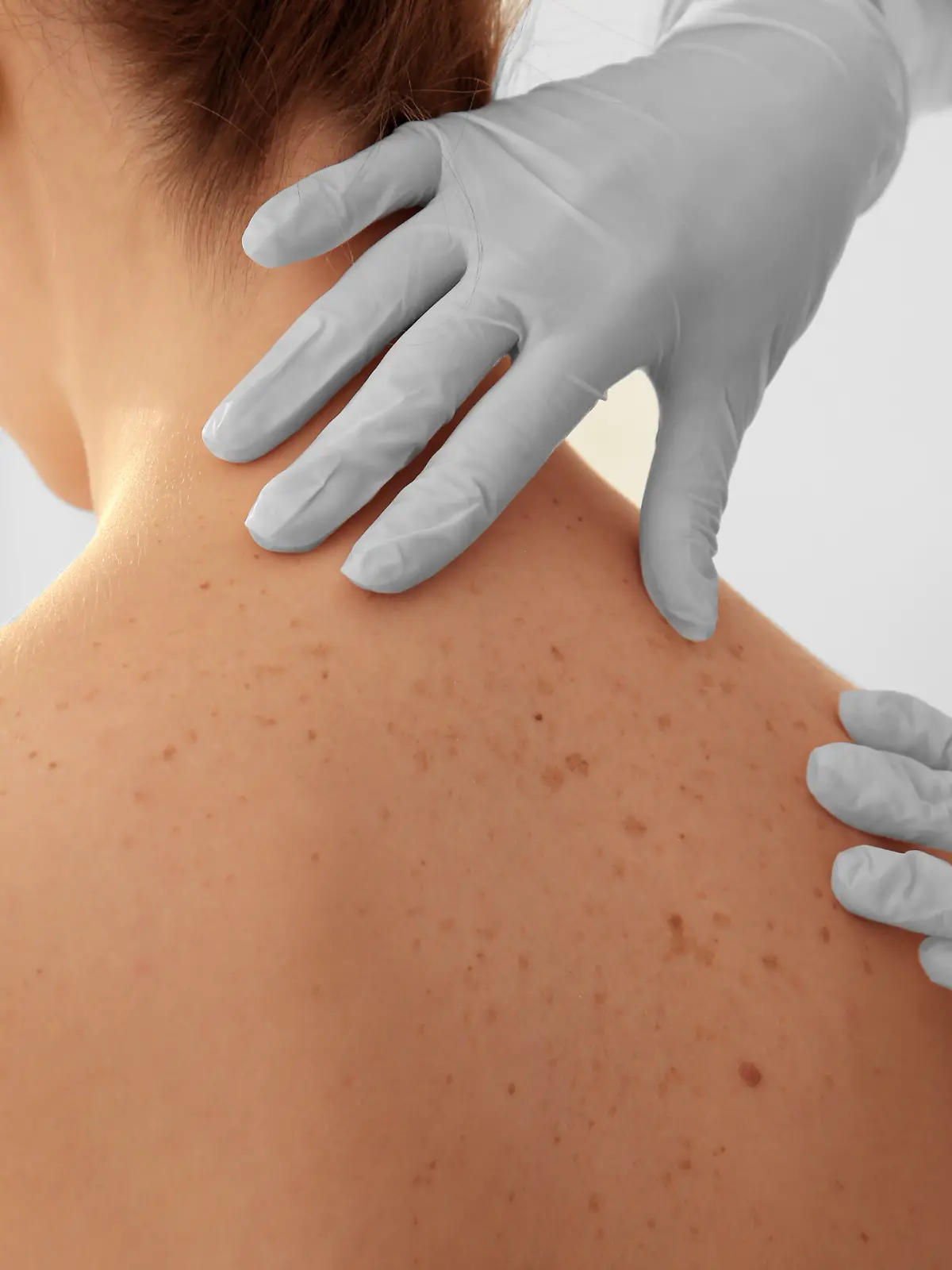 Dermatologe untersucht Patientin in der Klinik, Nahaufnahme