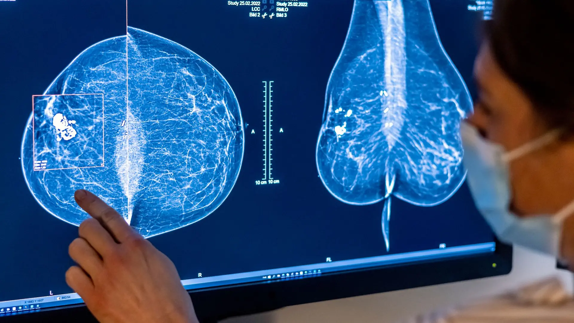 2023 wurden rund eine halbe Million Menschen in Deutschland mit Krebs diagnostiziert. (Symbolbild)