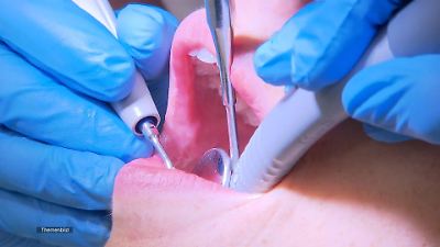 Arzt zieht falschen Zahn – Kieferchirurg vor Gericht in Siegburg