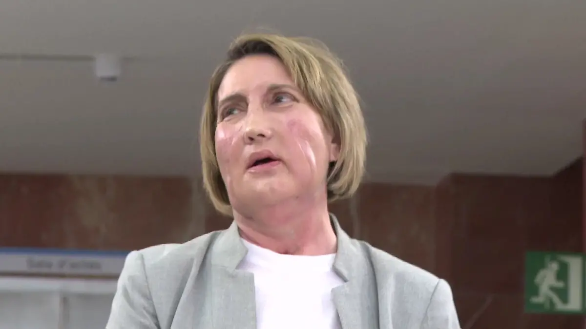 Gesichtstransplantation-einer-Toten-Carme-erh-lt-Gesicht-von-einer-Sterbehilfe-Spenderin-Spanien