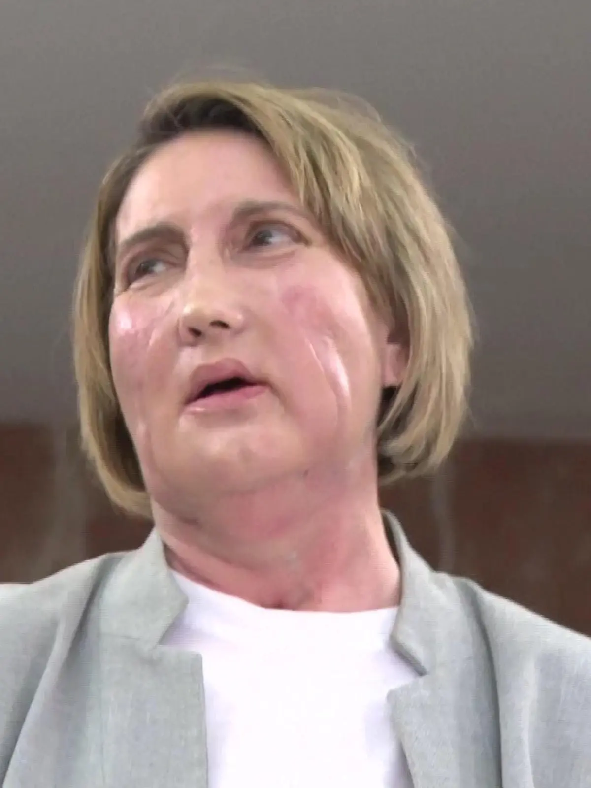 Bild zu: "Gesicht einer Toten transplantiert! Diese Frau hat endlich ihr Lachen zurück"